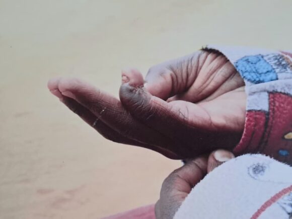 World Neglected Tropical Diseases Day: Strengthening Kenya’s Response to Snakebite Envenoming